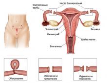Positive and negative consequences of sterilization for women