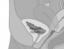 Simptomele îndoirii uterului și caracteristicile tratamentului acestuia